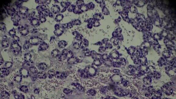显微镜下甲状腺癌活检