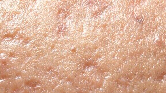 皮肤上的球状囊性痤疮皮肤科