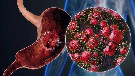 胃癌、消化性溃疡
