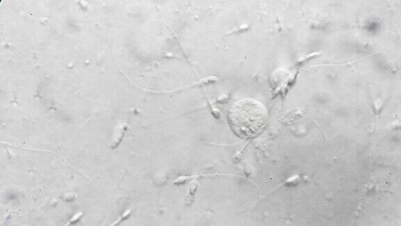 1000倍显微镜下病人的医学精子图检查中迟钝的精子