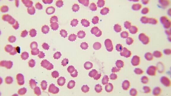 显微镜下的红细胞和白细胞总部的视频科学课在固定的和染色的样品上对人体血液成分的检验生化实验室高性能运动放大1000倍