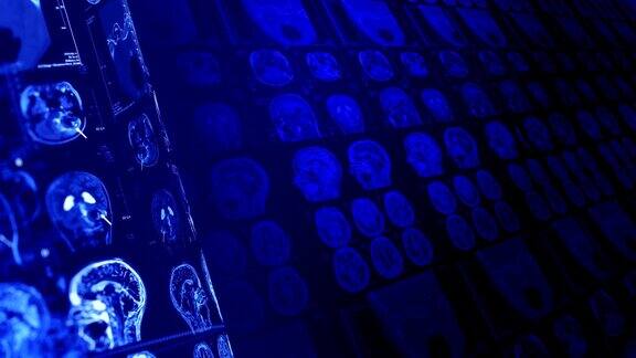 医学、临床背景人脑的x射线计算机断层扫描