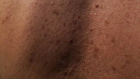 摄像机沿着患者背部皮肤移动皮肤上覆盖有良性或恶性痣