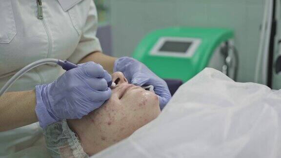 Cosmetological程序操作医生治疗有青春痘和痤疮的问题皮肤激光健康皮肤