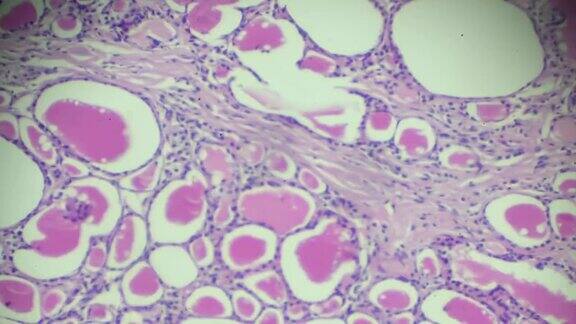 单纯甲状腺肿的人体病理标本光镜下不同部位