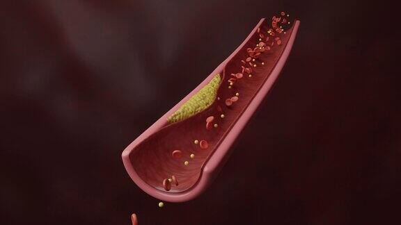 血管中的斑块和胆固醇