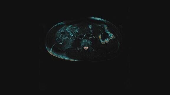 腹部的大量彩色CT扫描胃肠道、肝脏和肾脏的计算机断层摄影术