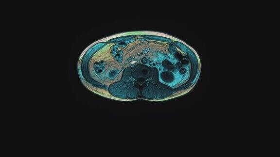 腹部的大量彩色CT扫描胃肠道、肝脏和肾脏的计算机断层摄影术