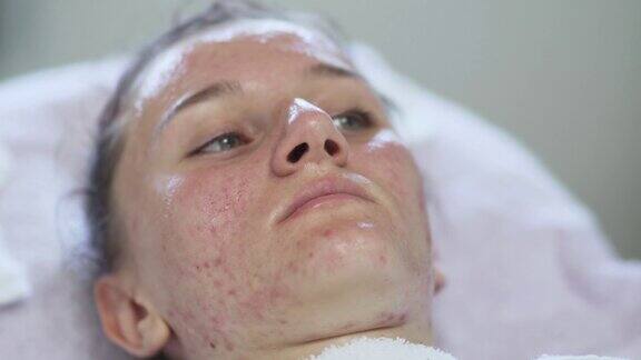 在专业美容师的办公室治疗痤疮近距离的面部一个年轻女子的油性痤疮皮肤接受痤疮治疗