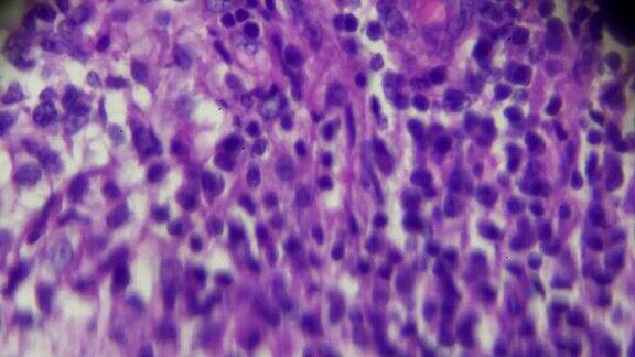 显微镜下淋巴结结核病理标本