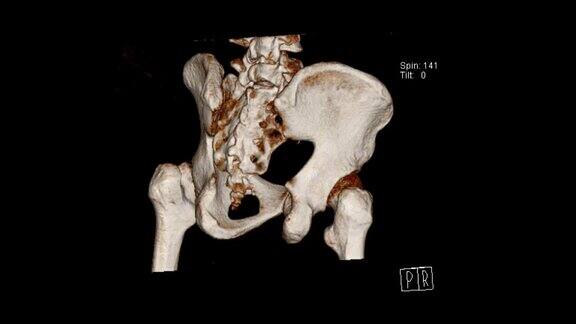 骨盆体积渲染检查显示左股骨颈骨折(CTVR骨盆)
