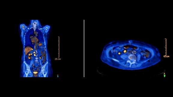 PETCT或正电子发射体层摄影术用于发现复发性肿瘤蓝色调轴向视图pet扫描冠状面和轴向面比较
