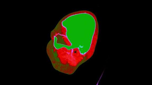 彩色模式下脑矢状面CT扫描或脑灌注诊断脑卒中疾病