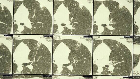 人类胸部与肋骨、脊柱和肺的磁共振成像(MRI)