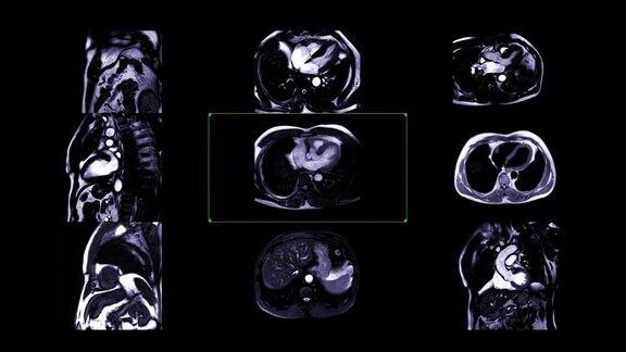 心脏MRI或心脏MRI(心脏磁共振成像)