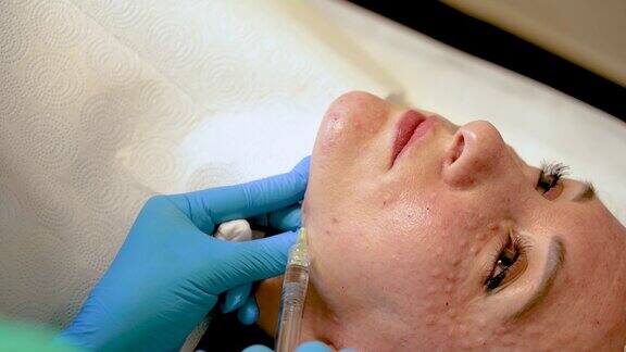 美容医生戴上手套在女性面部皮肤进行多次注射生物活化和面部拉皮