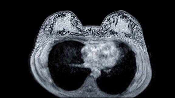 乳腺MRI或磁共振成像轴位T1W的女性乳腺癌筛查