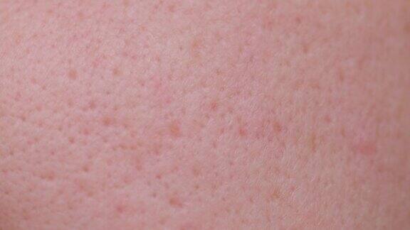 毛孔脏黑头粉刺的主要烦恼油性面部皮肤上毛孔粗大的微距照片