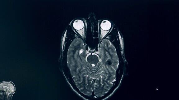 核磁共振成像过程中大脑的计算机图像