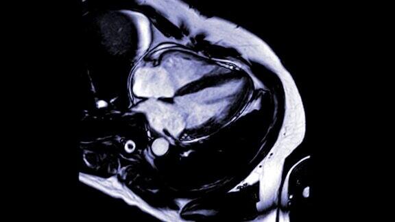 心脏MRI或心脏MRI4腔室视图