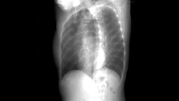 胸部CT扫描数据的胸部x线三维渲染