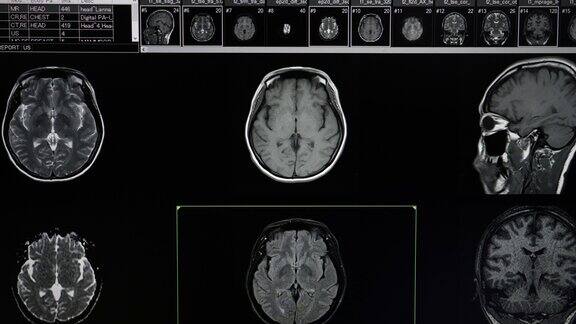 病人的脑部核磁共振扫描