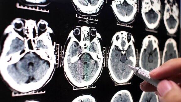 MRI脑部扫描x射线图像