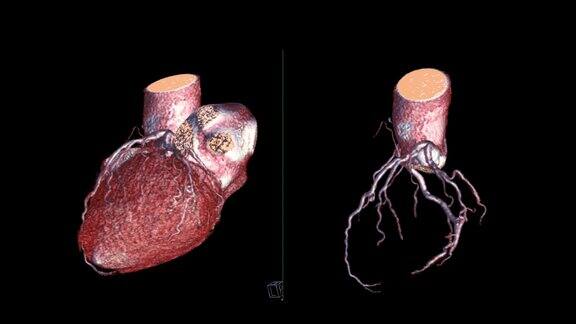 冠状动脉三维绘制
