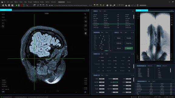 磁共振成像大脑和脊髓扫描模型与多窗口和数据医学研究软件模板与MRI结果的计算机显示器和笔记本电脑屏幕