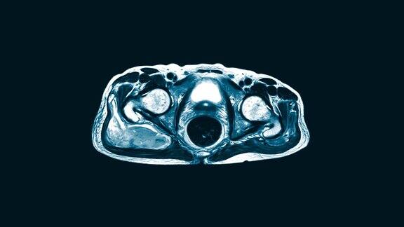 双髋矢状面磁共振成像(MRI)在右侧臀大肌和臀中肌肌内发现大量混杂的液体聚集