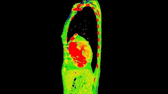 彩色模式下胸部矢状位CT扫描或PetCT扫描