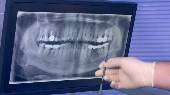 牙齿的x光全景照片和牙医的手与工具移动屏幕