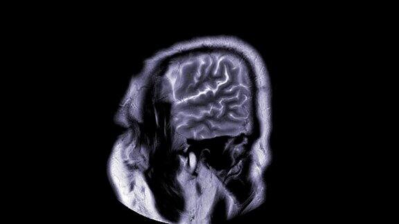 脑矢状面磁共振增强造影剂大脑的磁共振成像