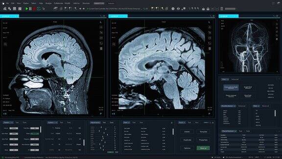 显示脑磁共振图像扫描实时过程的医疗软件界面真实的MRI有助于诊断神经系统疾病肿瘤损伤中风感染头痛