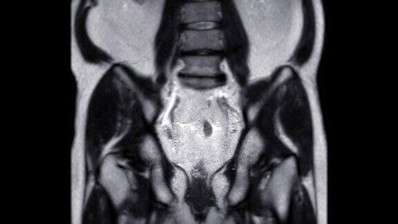 MRI前列腺