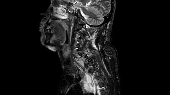 颈椎病史MRI:有交通事故史、颈椎损伤脱位、视野模糊、失焦医学