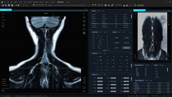 磁共振成像脊髓扫描模型与多窗口和数据专业医学研究软件模板与MRI结果的计算机显示器和笔记本电脑屏幕