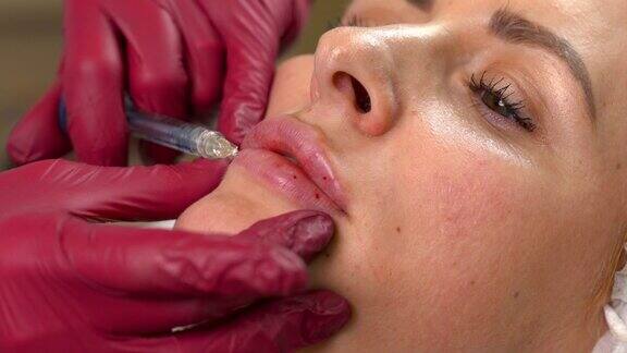 年轻女子嘴唇有透明质酸注射的特写唇填料