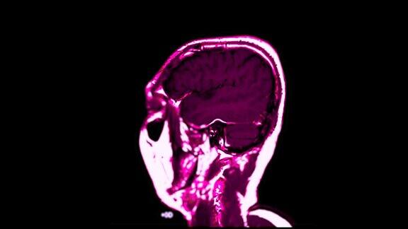 大脑矢状面MRI