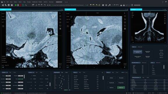 磁共振成像脑扫描模型与多窗口和数据医学研究环境软件模板与MRI结果的计算机显示器和笔记本电脑屏幕