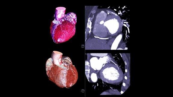 冠状动脉三维绘制