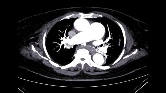 CT轴位CTA胸主动脉三维成像