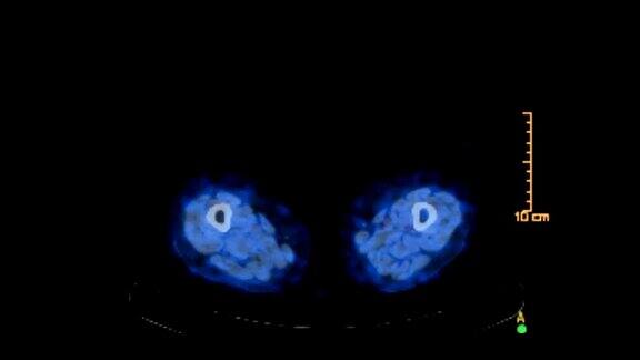 PETCT或正电子发射体层摄影术用于发现复发性肿瘤蓝色调轴向视图pet扫描