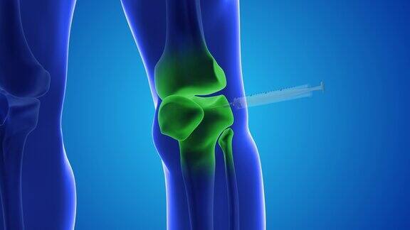一个动画显示干细胞被注射到人类的膝盖