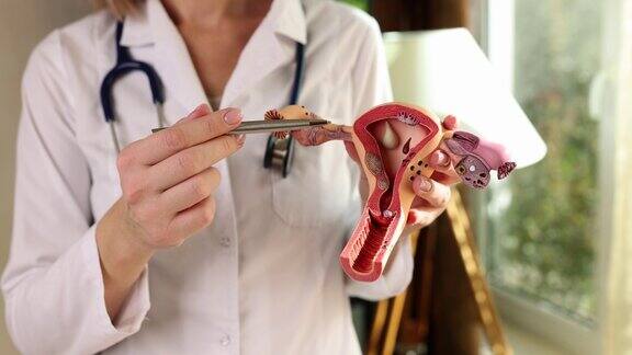 妇科医生拿着子宫解剖和卵巢临床特写