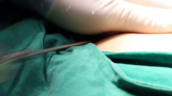 4K抽脂美容手术库存视频特写镜头医生从腹部取出脂肪的过程开始抽脂手术抽脂串和注射器库存视频