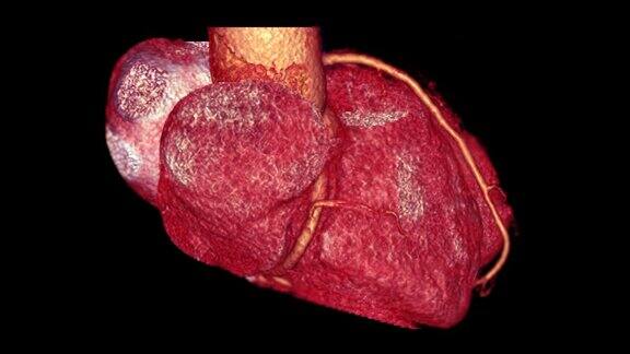 CTA冠状动脉3D渲染图