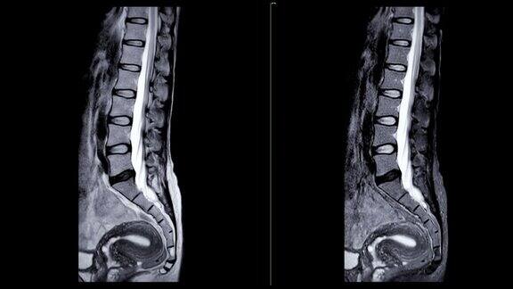 脊柱MRI条件下
