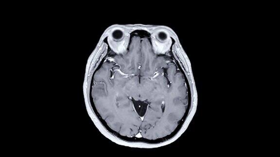 注射钆造影剂后脑轴位T1FS的MRI