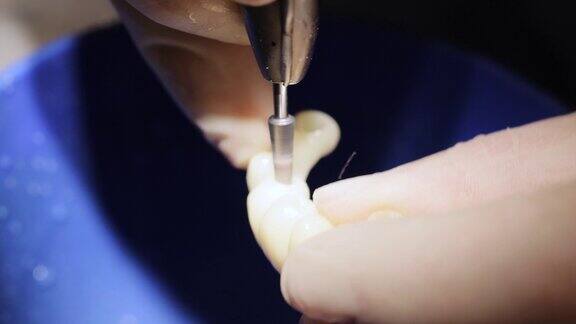 男性牙科技师在牙科实验室用钻头的特写义齿人工牙义肢手工制作的假牙假牙将陶瓷材料应用于牙冠